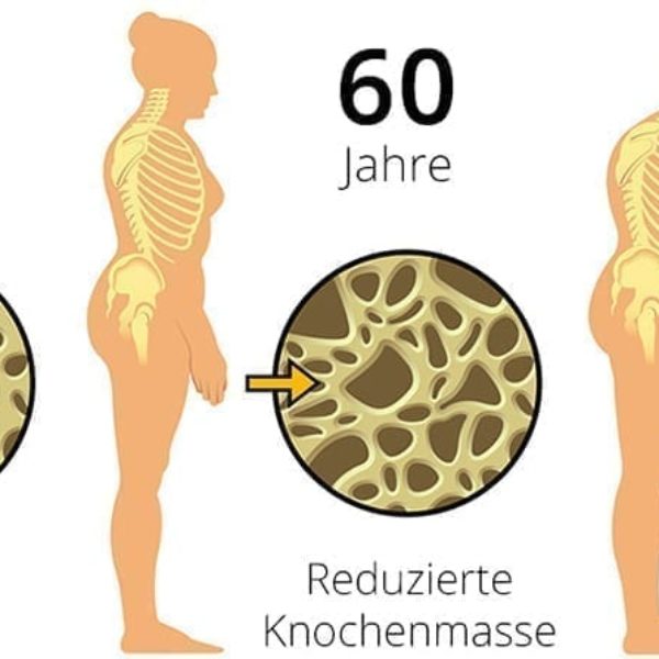 osteoporose_01