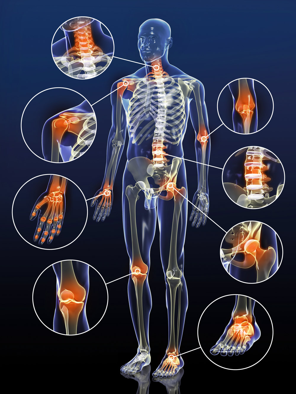 Arthrose_Koerperschnitt Arthrose_Koerperschnitt
